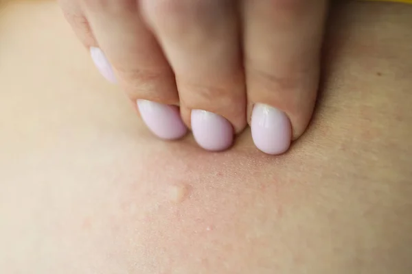 Vrouwelijke Hand Raakt Huid Met Huiduitslag Dermatoloog Onderzoekt Eczeem Patiënt — Stockfoto