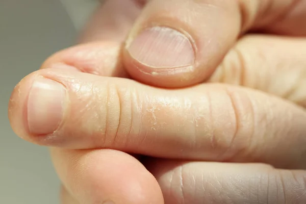 Pele Doente Com Eczema Nos Dedos Paciente Fala Sobre Queixas — Fotografia de Stock