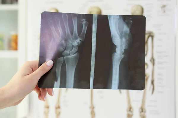 Die Hand Des Arztes Mit Dem Röntgenbild Der Handfläche Und — Stockfoto