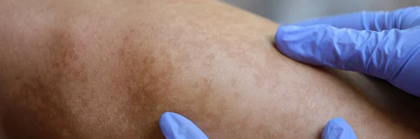 Mãos Doutor Luvas Protetoras Borracha Verificam Pele Jovem Com Vitiligo — Fotografia de Stock