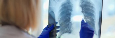 Doktor röntgen cihazını hastanede tutuyor. Zatürree covid-19 ve bronşit teşhisi