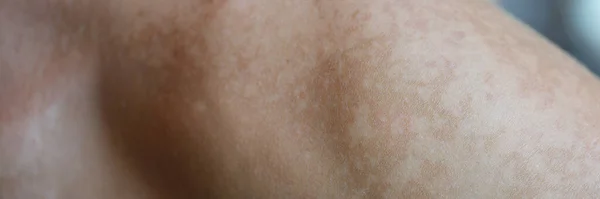 Skin Care Problem Spots Shoulder Skin Health Concept Melasma Pigment — Stock Photo, Image