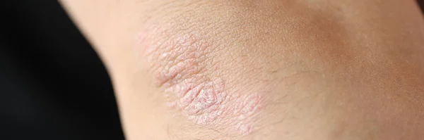 Psoriatic Plaques Elbow Patient Skin Disease Closeup Diagnosis Treatment Psoriasis — Stock Photo, Image