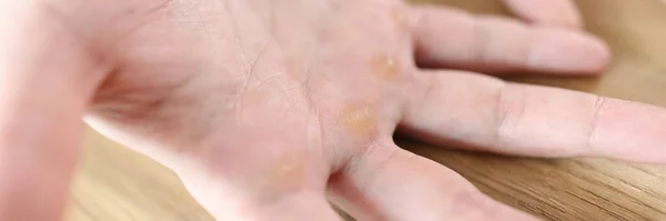 Calluses Distal Palmar Surface Hands Man Showing His Hands Corns — Stock Photo, Image