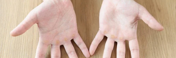 Many Calluses Distal Palmar Surface Hands Male Hands Calluses Wooden — Φωτογραφία Αρχείου