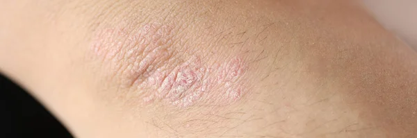 Damaged, dry itchy skin on elbow area close-up. Skin care and health problems concept.