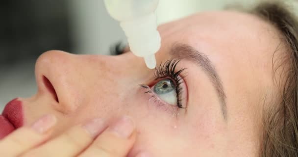 Γυναίκα Βάζει Οφθαλμικές Σταγόνες Στεγνά Ερεθισμένα Μάτια Κυρία Χρησιμοποιεί Αντιισταμινικό — Αρχείο Βίντεο