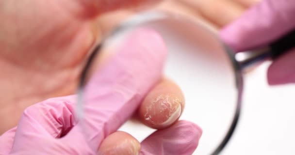 피부과 의사는 유리를 손가락에 피부를 껍질을 검사합니다 — 비디오