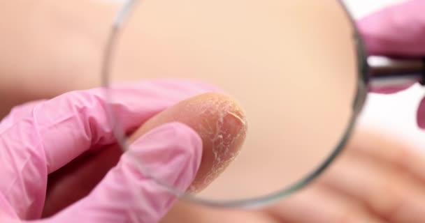 Patient Showing Dry Hands Peeling Skin Dermatologist Treatment Fungus Fingers — Stock Video