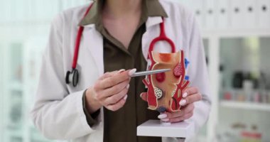 Doktor rektumu hastanede hemoroit gerçekçi bir modelle gösteriyor. Kadın, klinikteki randevusundaki hasta için hastalık geliştirme risklerini anlatıyor