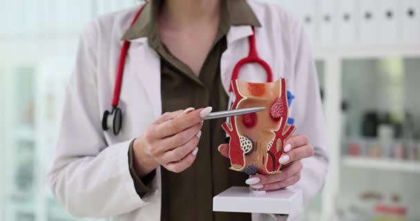 Doctorul Demonstrează Rectul Hemoroizi Model Realist Spital Femeia Explică Riscurile — Videoclip de stoc