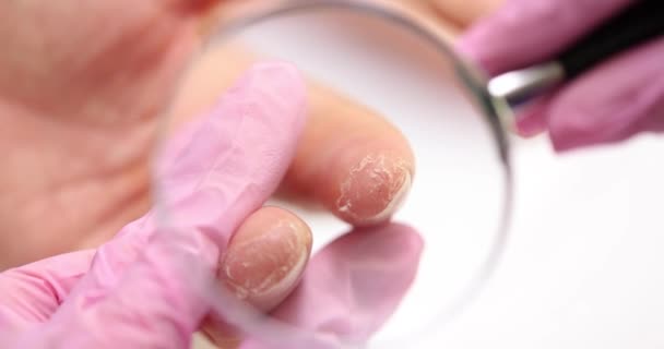Mãos Secas Pele Descascada Micose Homem Mostra Mãos Dermatologista Hidratando — Vídeo de Stock