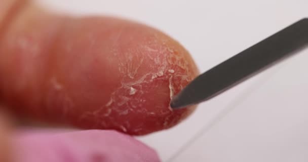 화장품 전문가는 손가락으로 피부를 분석합니다 건선과 습진을 손가락 — 비디오