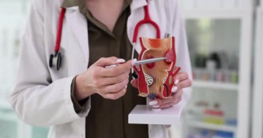 Rektum, hemoroit ve kabızlık hastalıklarının tedavisi. Proktolojist anatomik modelde rektum patolojisi gösteriyor