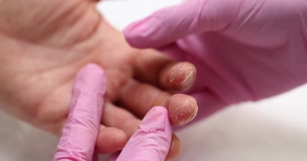 Patient Mit Trockenen Hautschmerzen Zeigefinger Besorgt Über Verschlechterung Seines Gesundheitszustandes — Stockvideo