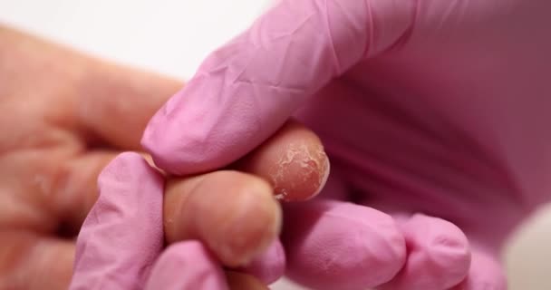 医師は皮膚の剥離を検査する患者の指を調べます 皮膚を剥離することに集中した手の詳細な検査を実施 — ストック動画