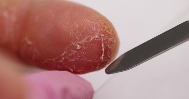 Γιατρός Γλιστρά Ιατρικό Όργανο Πάνω Ξεφλούδισμα Του Δέρματος Γιατρός Χρησιμοποιεί — Αρχείο Βίντεο