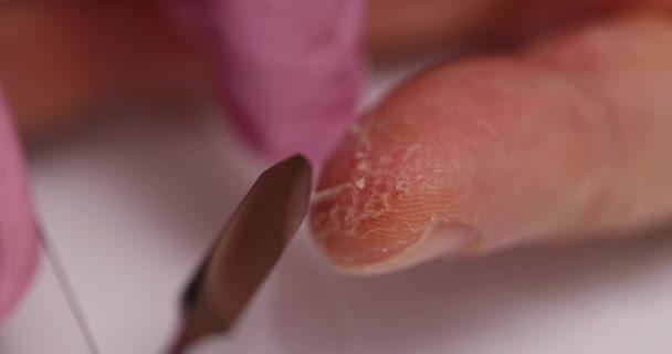 医師は診療所で患者の指の問題のある皮膚からスクラップを取ります 皮膚や皮膚の病気や乾癬を手で — ストック動画