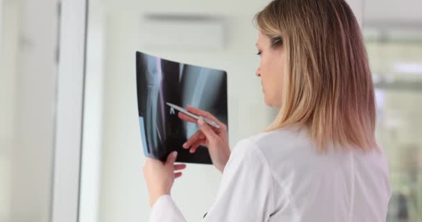 Die Traumatologie Untersucht Die Ergebnisse Einer Röntgenuntersuchung Der Hand Arthrose — Stockvideo