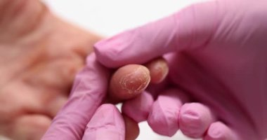 Doktor, kurumuş ciltli hasta parmağını muayene ediyor. El derisi sorunu ve alerjisi.