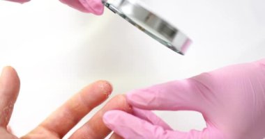 Dermatolog hasta parmağını büyüteçle muayene ediyor. El derisinin soyulması ve sedef hastalığı.