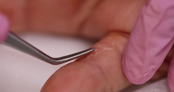 Läkaren Avlägsnar Huden Från Patientens Finger Skalning Och Psoriasis Huden — Stockvideo
