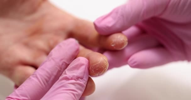 피부과 의사는 환자의 손가락을 벗겨내는 징후를 드러냅니다 의사는 피부학적 상태에 — 비디오