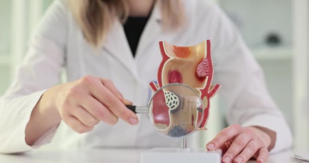 Anatomical Model Diseased Colon Magnifying Glass Hands Doctor Diseases Rectum — Stock Video