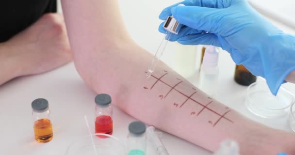 Hautprickeltest Auf Allergien Der Hand Eines Patienten Einem Medizinischen Labor — Stockvideo