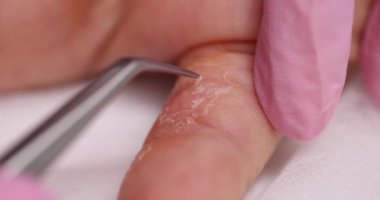 Doktor deriyi parmağından soyar. Egzama alerjisi ve sedef hastalığı.