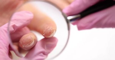 Doktor hasta parmağındaki sedef hastalığının şiddetini inceliyor. El dermatiti tedavisine ve