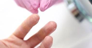 Hasta doktor randevusunda parmak derisinin soyulduğunu gösteriyor. Dermatolog, ciddiyet ve potansiyel nedenlere dikkat çeken eller inceliyor