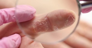 Doktor parmak derisini büyüteçle inceliyor. Dermatolojist durumu yakından inceledi. Olası nedenleri araştıran ciddiyete dikkat çekti.
