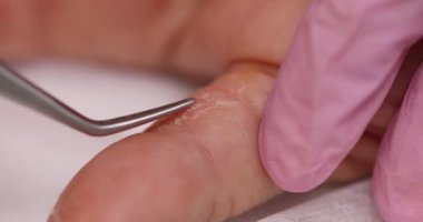 Dermatolog, özel cımbızla zarar görmüş deriyi parmaktan ayırıyor. Doktor, tedavi stratejisi için gerekli araçları kullanır.