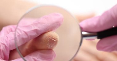 Parmak üzerinde kurumuş ve çatlamış deri. Pembe eldivenli doktor hasta ellerinin çivi ve derisini büyüteç kullanarak inceliyor.