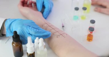 Klinikteki hastanın eline alerji testi yapıldı. Deri alerjisi testleri
