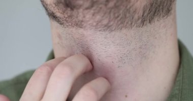 Sakallı ve derili bir erkek boynu. Boynum kaşınıyor. Sebep ve teşhis koyabiliyorum.