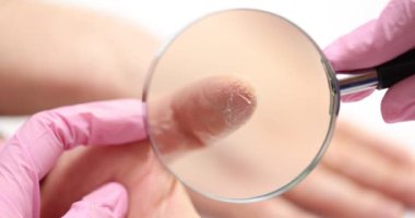 Dermatoloji kliniğinde büyüteç kullanarak parmaktaki cilt hastalığının detaylı incelemesi. Ellerinde egzama sedef hastalığı var.
