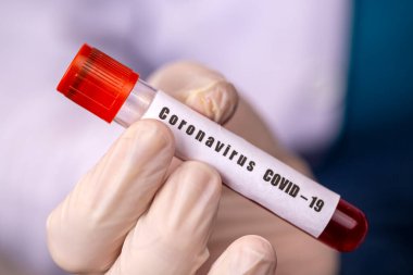 Doktor Holding Coronavirus 2019 nCoV Kan Numunesi Pozitif Test Tüpü. Tıbbi eldiven giyen doktor, hastanın korona virüsü içeren kan test tüpünü gösterir (COVID-19)