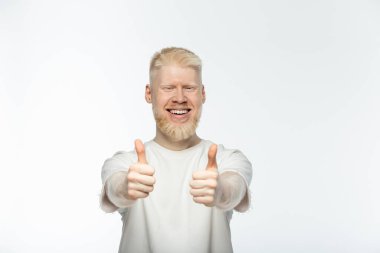 Tişörtlü sakallı albino adam gülümsüyor ve parmaklarını beyazın üstünde gösteriyor. 