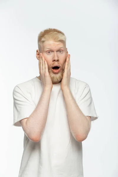 stock image shocked albino man in t-shirt touching face and looking at camera on white 