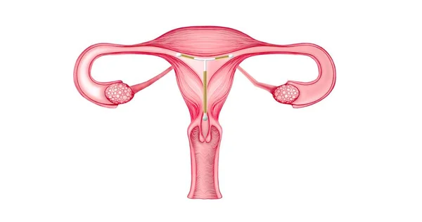 Sistema Riproduttivo Femminile Con Dispositivo Intrauterino All Interno Illustrazione Organi — Foto Stock