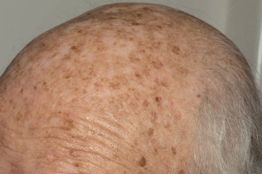 Yaşlı bir bireyin kafasının detaylı bir şekilde çekimleri, incelen gri saçlara, kırışık kafa derisine ve çeşitli deri beneklerine odaklanarak, doğal yaşlanma sürecini vurguluyor.