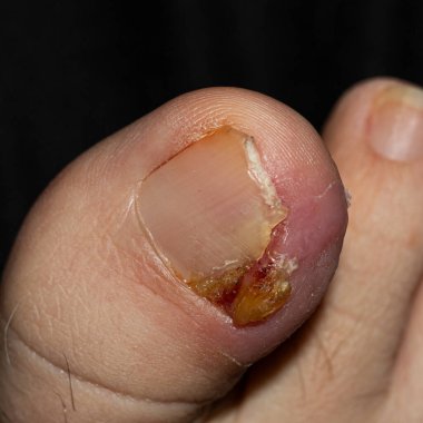 Travma geçiren bir insan ayak tırnağının detaylı makro çekimi, saflık ve iyileşme aşamaları gösteriyor. Tıp eğitimi, sağlık eğitimi ve hasta eğitim kaynakları için kullanışlı