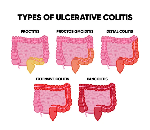 Tipos Colitis Ulcerosa Infografías Incluyendo Proctitis Colitis Distal Pancolitis Proctosigmoiditis — Vector de stock