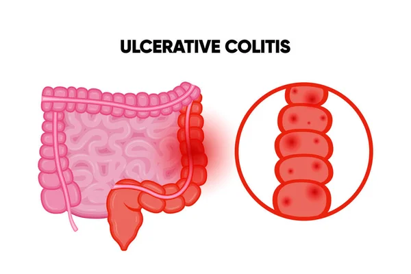Colitis Ulcerosa Entzündliche Darmerkrankungen Geschwüre Und Entzündungen Des Verdauungstraktes Bauchschmerzen — Stockvektor