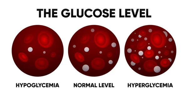Glucosa Vaso Sanguíneo Niveles Normales Hiperglucemia Hipoglucemia Azúcar Normal Alta — Vector de stock