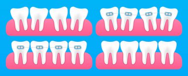 Ortodontik diş telleriyle yapılan diş düzeltmeleri. Diş dizilimi aşamaları, düzeltmeden önce ve sonra parantez ile. Diş macununun diş modeli. Vektör İllüstrasyonu