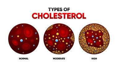 Düz tarzda kolesterol. LDL ve HDI seviyesi. Arterioskleroz, enfarktüs, iskemi, tromboz hastalığı. İnsan damarlarında kolesterol. Vektör illüstrasyonu