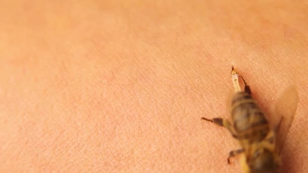 蜜蜂刺人的胳膊 蜜蜂叮咬时 会离开毒液囊 它仍在自行注射毒液 毒液囊 蜜蜂对昆虫叮咬过敏 — 图库视频影像